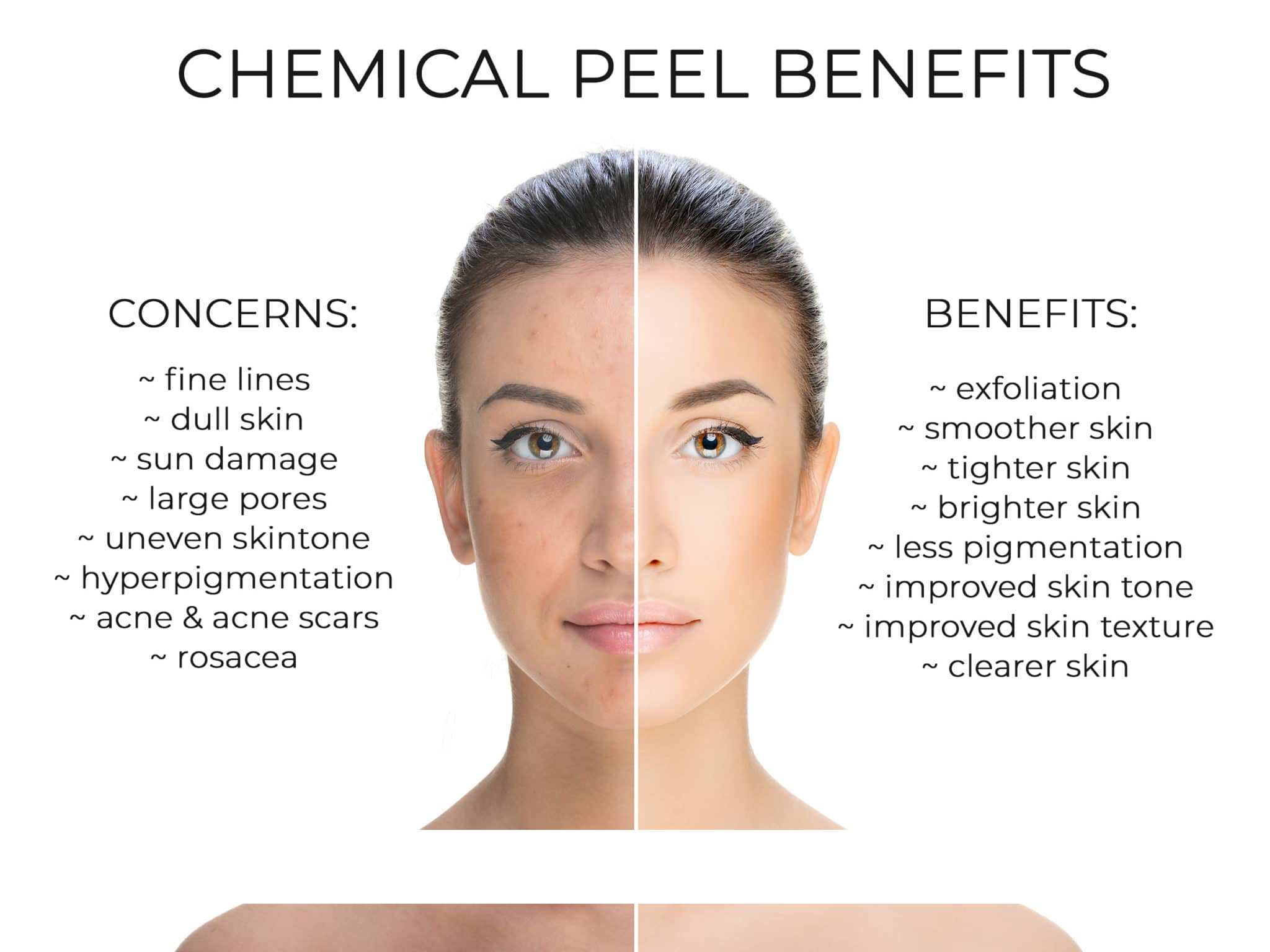 The Peel Deal - The Risks And The Benefits Of Chemical Skin Peels — Lumiere  Medispa - Skin Health & Rejuvenation Clinic